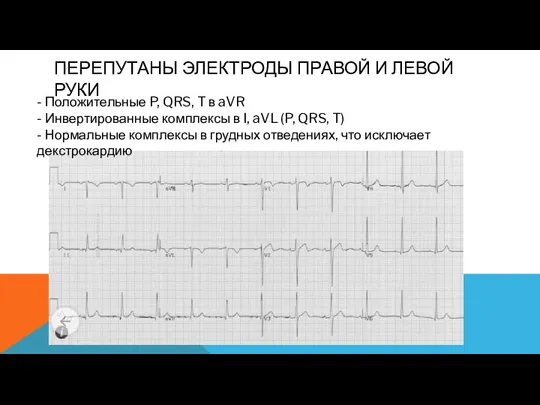 ПЕРЕПУТАНЫ ЭЛЕКТРОДЫ ПРАВОЙ И ЛЕВОЙ РУКИ - Положительные P, QRS, T в