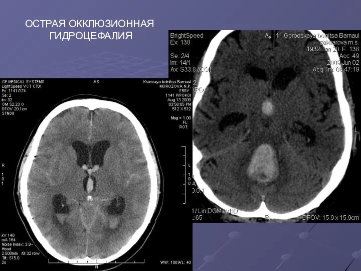 ОСТРАЯ ОККЛЮЗИОННАЯ ГИДРОЦЕФАЛИЯ