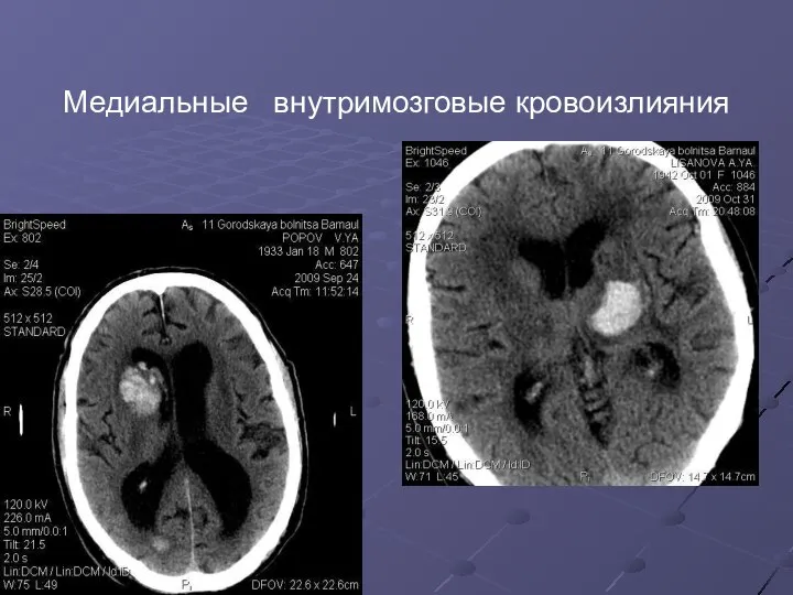 Медиальные внутримозговые кровоизлияния