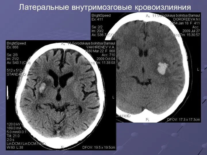 Латеральные внутримозговые кровоизлияния