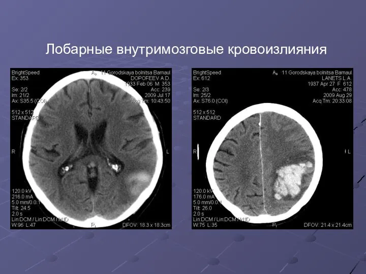 Лобарные внутримозговые кровоизлияния