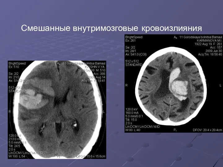 Смешанные внутримозговые кровоизлияния