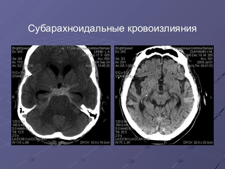 Субарахноидальные кровоизлияния