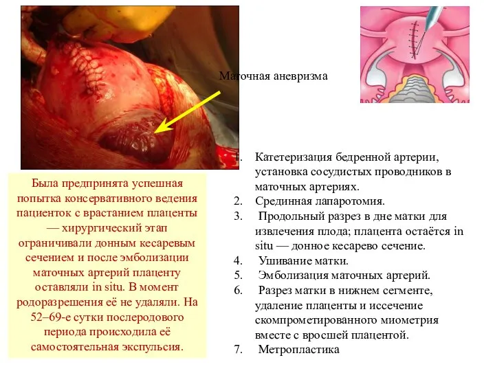 Маточная аневризма Катетеризация бедренной артерии, установка сосудистых проводников в маточных артериях. Срединная