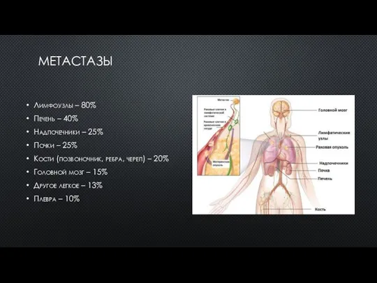 МЕТАСТАЗЫ Лимфоузлы – 80% Печень – 40% Надпочечники – 25% Почки –