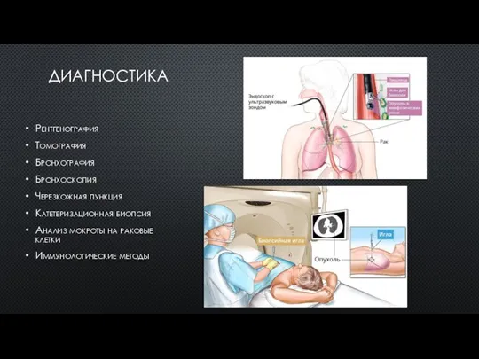 ДИАГНОСТИКА Рентгенография Томография Бронхография Бронхоскопия Черезкожная пункция Катетеризационная биопсия Анализ мокроты на раковые клетки Иммунологические методы