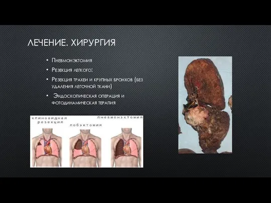 ЛЕЧЕНИЕ. ХИРУРГИЯ Пневмонэктомия Резекция легкого: Резекция трахеи и крупных бронхов (без удаления