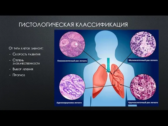 ГИСТОЛОГИЧЕСКАЯ КЛАССИФИКАЦИЯ От типа клеток зависит: Скорость развития Степень злокачественности Выбор лечения Прогноз