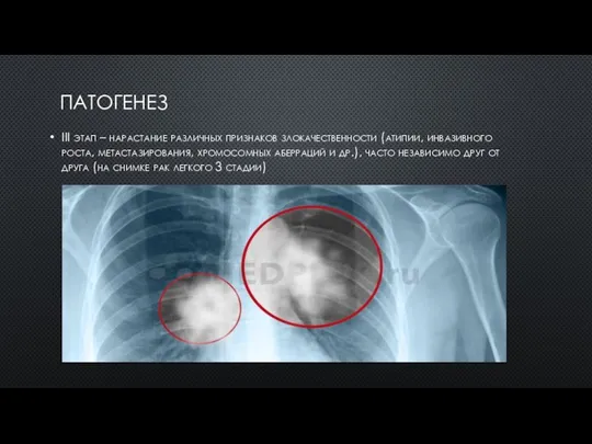 ПАТОГЕНЕЗ III этап – нарастание различных признаков злокачественности (атипии, инвазивного роста, метастазирования,