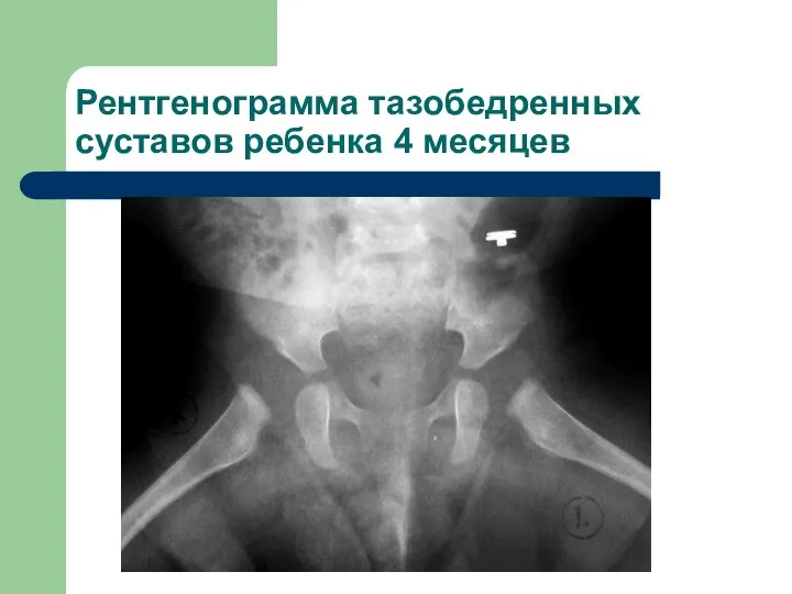 Рентгенограмма тазобедренных суставов ребенка 4 месяцев