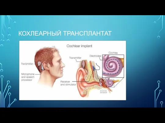 КОХЛЕАРНЫЙ ТРАНСПЛАНТАТ