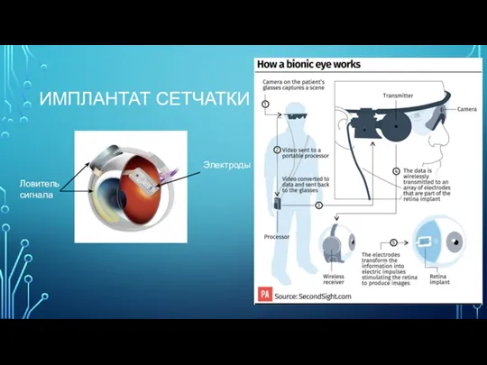 ИМПЛАНТАТ СЕТЧАТКИ Ловитель сигнала Электроды