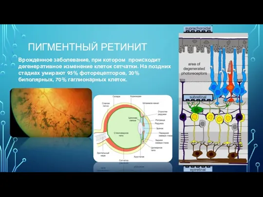 ПИГМЕНТНЫЙ РЕТИНИТ Врожденное заболевание, при котором происходит дегенеративное изменение клеток сетчатки. На