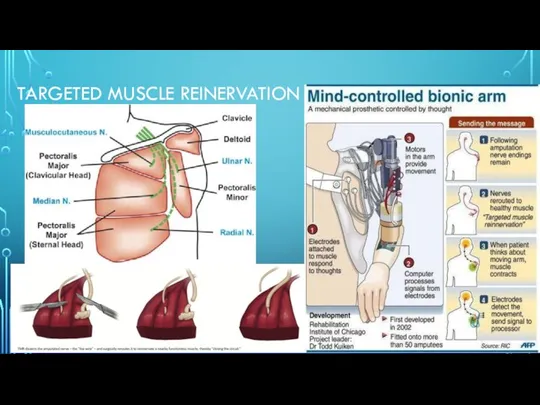 TARGETED MUSCLE REINERVATION