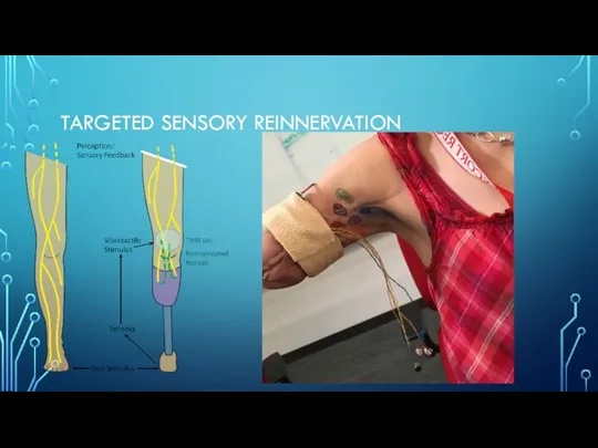 TARGETED SENSORY REINNERVATION