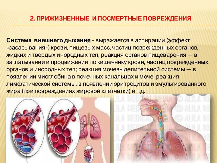 2. ПРИЖИЗНЕННЫЕ И ПОСМЕРТНЫЕ ПОВРЕЖДЕНИЯ Система внешнего дыхания - выражается в аспирации