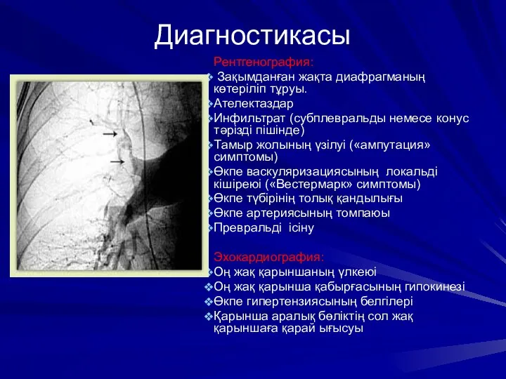 Рентгенография: Зақымданған жақта диафрагманың көтеріліп тұруы. Ателектаздар Инфильтрат (субплевральды немесе конус тәрізді