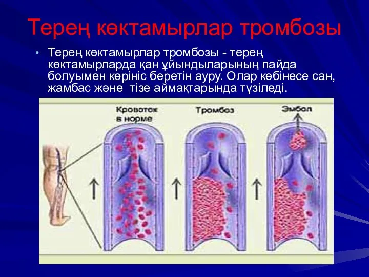 Терең көктамырлар тромбозы - терең көктамырларда қан ұйындыларының пайда болуымен көрініс беретін