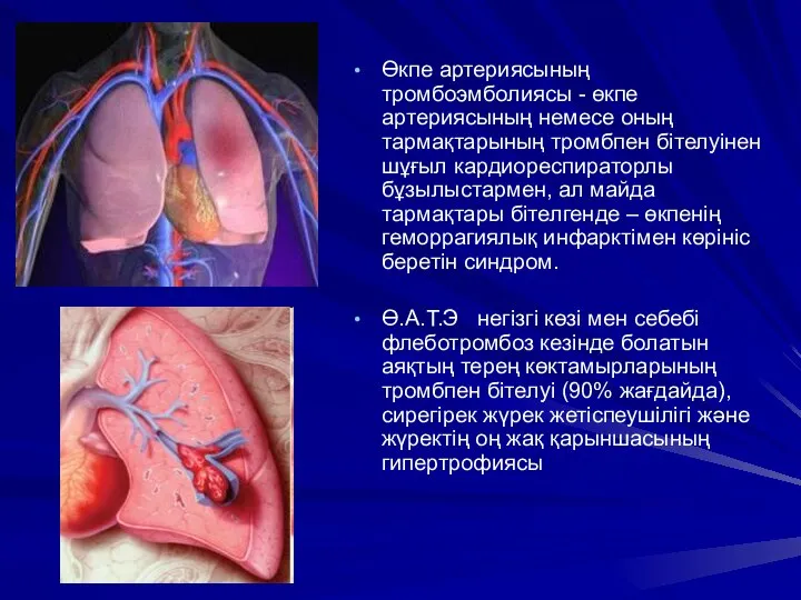 Өкпе артериясының тромбоэмболиясы - өкпе артериясының немесе оның тармақтарының тромбпен бітелуінен шұғыл
