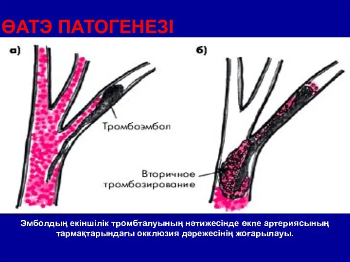 ӨАТЭ ПАТОГЕНЕЗІ Эмболдың екіншілік тромбталуының нәтижесінде өкпе артериясының тармақтарындағы окклюзия дәрежесінің жоғарылауы.