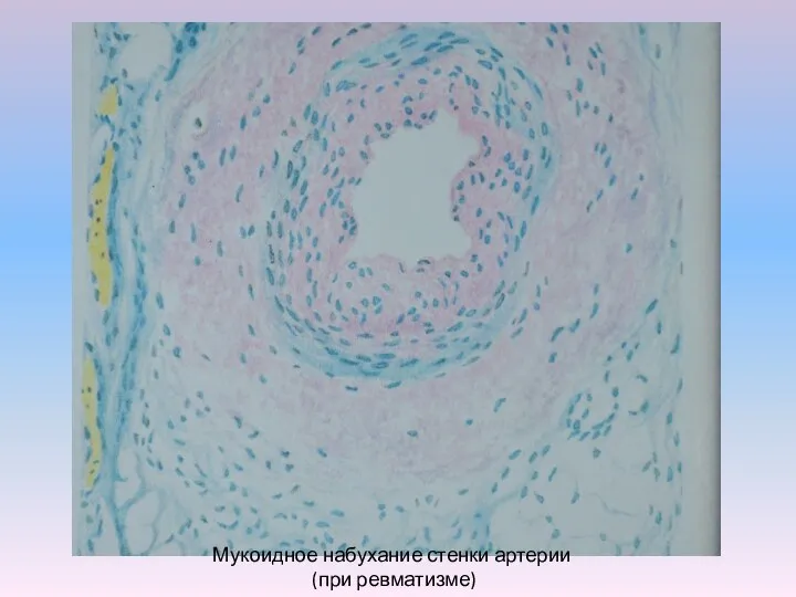 Мукоидное набухание стенки артерии (при ревматизме)