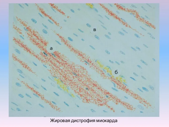 Жировая дистрофия миокарда