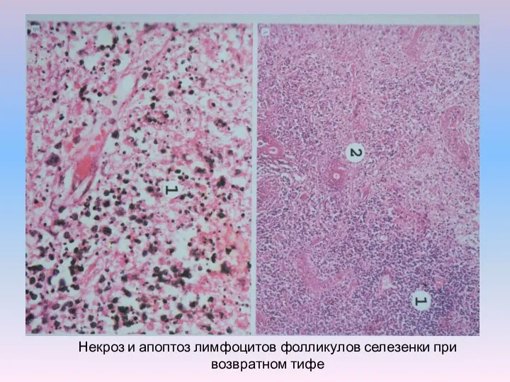 Некроз и апоптоз лимфоцитов фолликулов селезенки при возвратном тифе