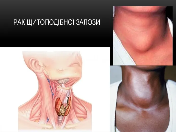 РАК ЩИТОПОДІБНОЇ ЗАЛОЗИ