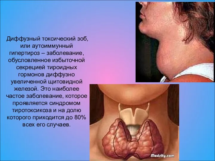 Диффузный токсический зоб, или аутоиммунный гипертироз – заболевание, обусловленное избыточной секрецией тироидных