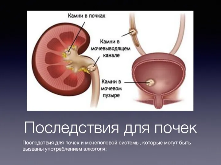 Последствия для почек Последствия для почек и мочеполовой системы, которые могут быть вызваны употреблением алкоголя: