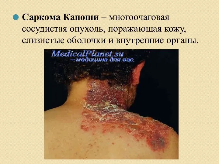 Саркома Капоши – многоочаговая сосудистая опухоль, поражающая кожу, слизистые оболочки и внутренние органы.