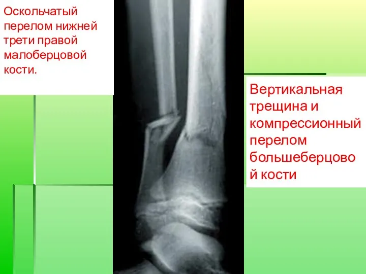 Вертикальная трещина и компрессионный перелом большеберцовой кости Оскольчатый перелом нижней трети правой малоберцовой кости.