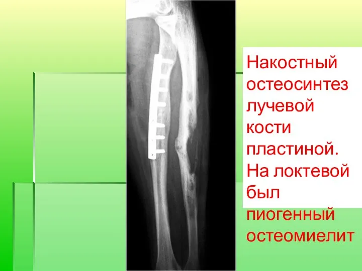 Накостный остеосинтез лучевой кости пластиной. На локтевой был пиогенный остеомиелит