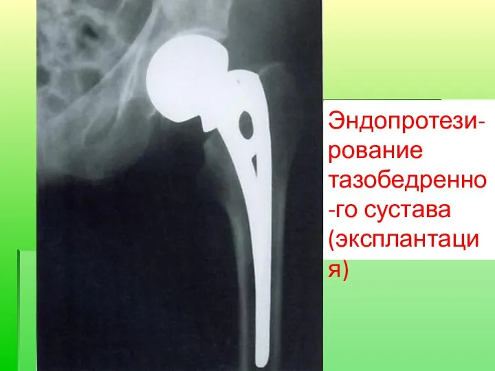 Эндопротези-рование тазобедренно-го сустава (эксплантация)