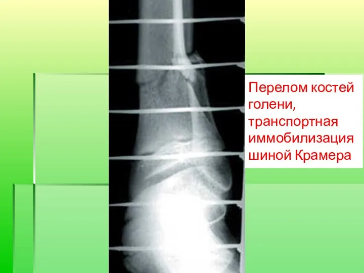 Перелом костей голени, транспортная иммобилизация шиной Крамера