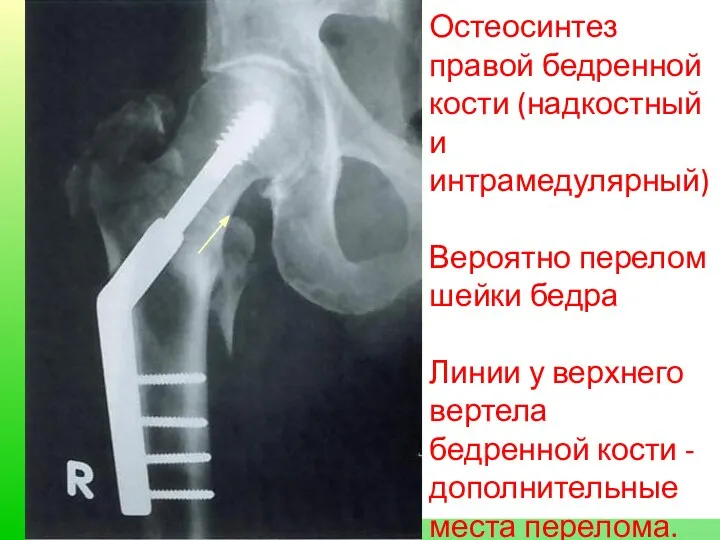 Остеосинтез правой бедренной кости (надкостный и интрамедулярный) Вероятно перелом шейки бедра Линии