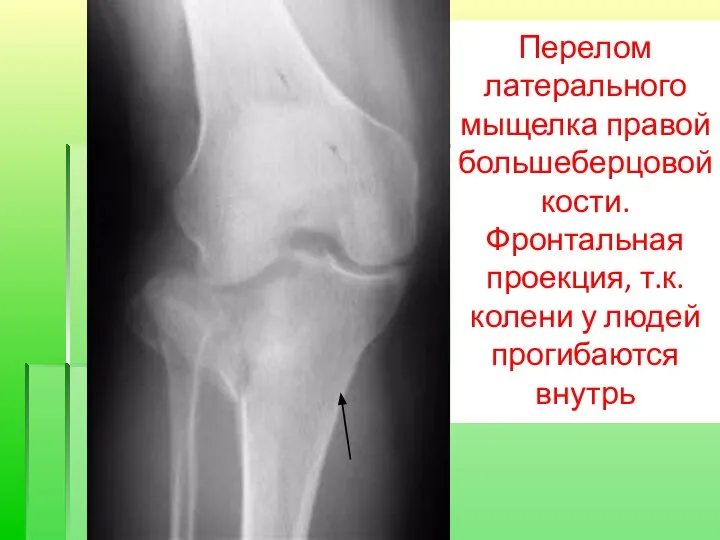 Перелом латерального мыщелка правой большеберцовой кости. Фронтальная проекция, т.к. колени у людей прогибаются внутрь