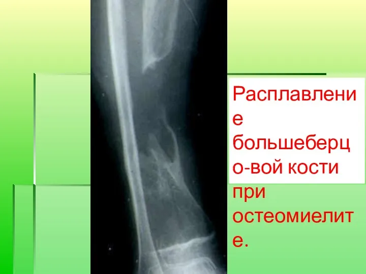 Расплавление большеберцо-вой кости при остеомиелите.