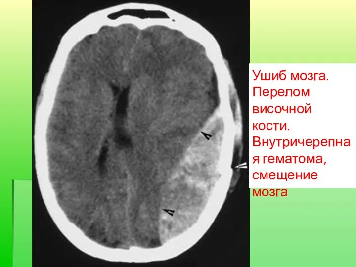 Ушиб мозга. Перелом височной кости. Внутричерепная гематома, смещение мозга