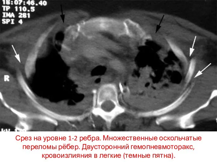 Срез на уровне 1-2 ребра. Множественные оскольчатые переломы рёбер. Двусторонний гемопневмоторакс, кровоизлияния в легкие (темные пятна).