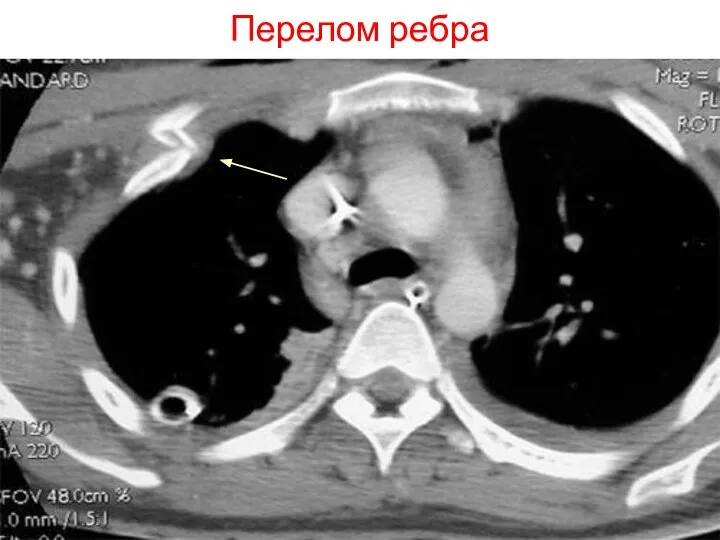 Перелом ребра