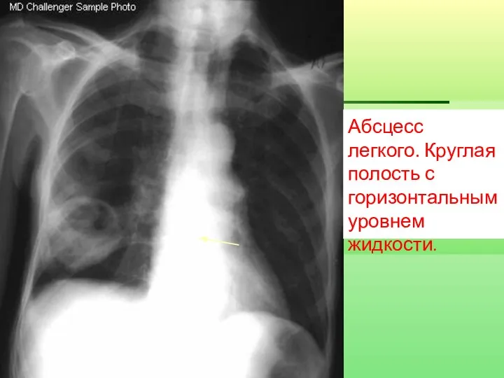 Абсцесс легкого. Круглая полость с горизонтальным уровнем жидкости.