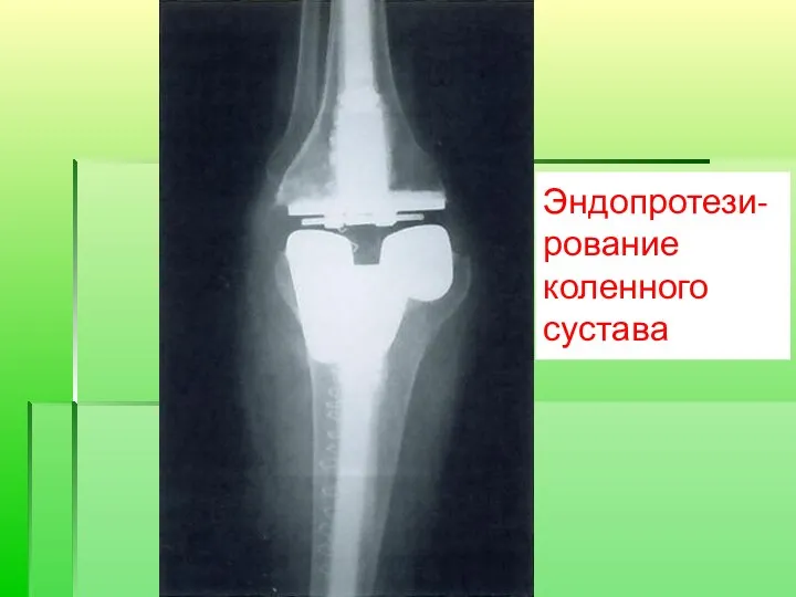 Эндопротези-рование коленного сустава