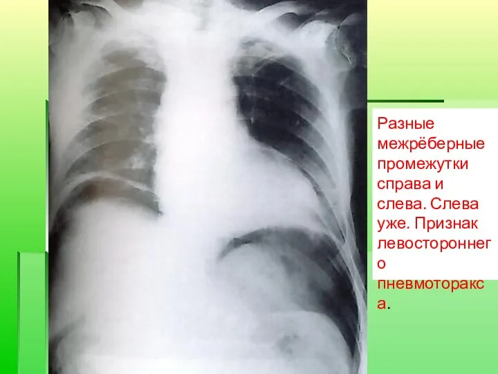 Разные межрёберные промежутки справа и слева. Слева уже. Признак левостороннего пневмоторакса.