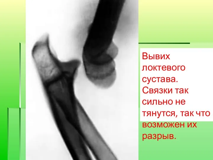 Вывих локтевого сустава. Связки так сильно не тянутся, так что возможен их разрыв.