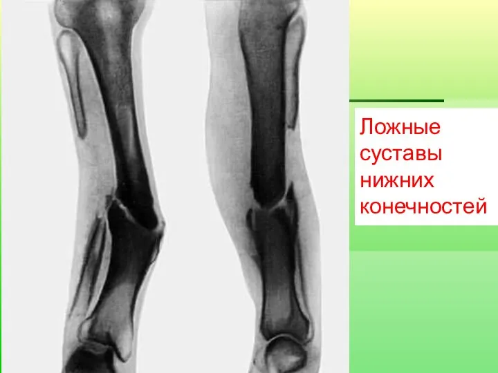 Ложные суставы нижних конечностей