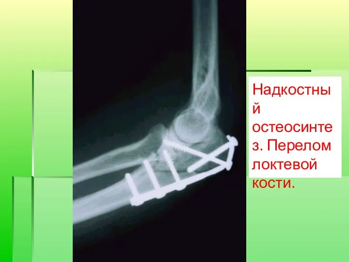 Надкостный остеосинтез. Перелом локтевой кости.