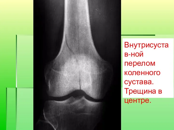 Внутрисустав-ной перелом коленного сустава. Трещина в центре.