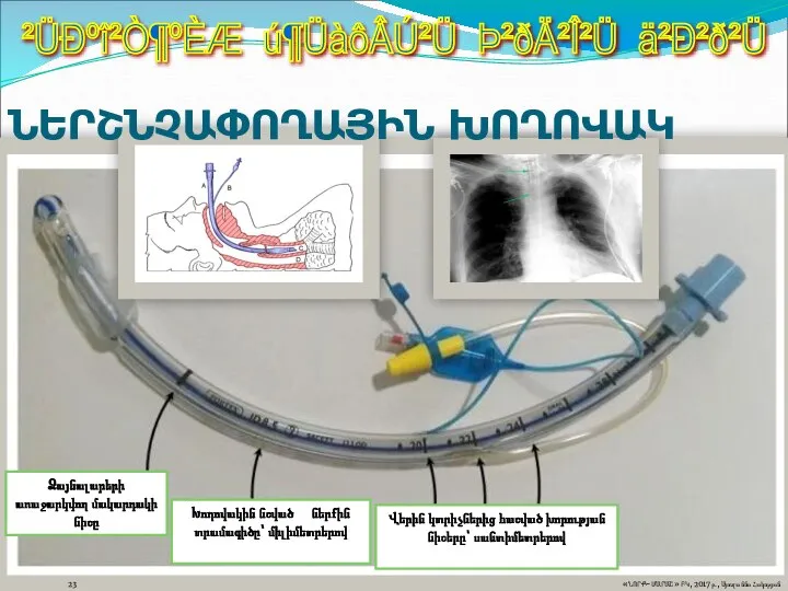 23 «ՆՈՐՔ-ՄԱՐԱՇ» ԲԿ, 2017թ., Սյուզաննա Հակոբյան ²ÜÐºî²Ò¶ºÈÆ ú¶ÜàôÂÚ²Ü Þ²ðÄ²Î²Ü ä²Ð²ð²Ü ՆԵՐՇՆՉԱՓՈՂԱՅԻՆ ԽՈՂՈՎԱԿ