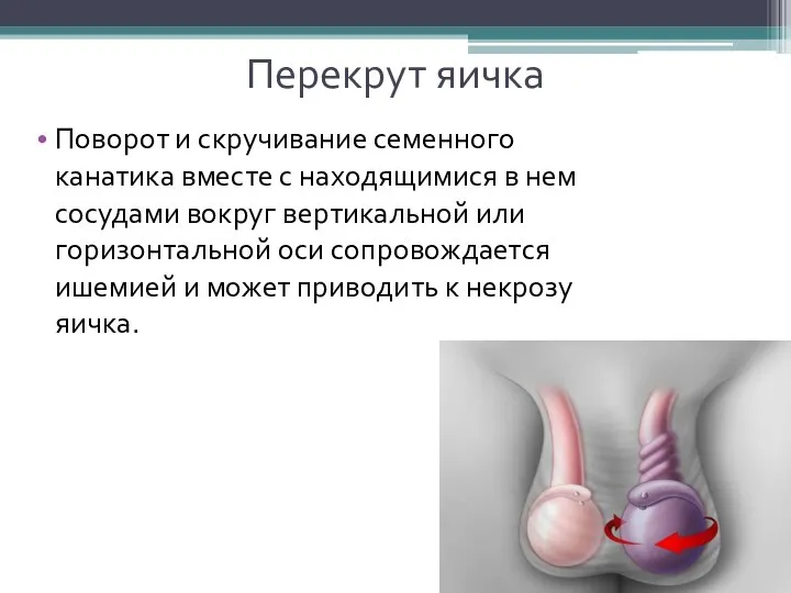 Перекрут яичка Поворот и скручивание семенного канатика вместе с находящимися в нем